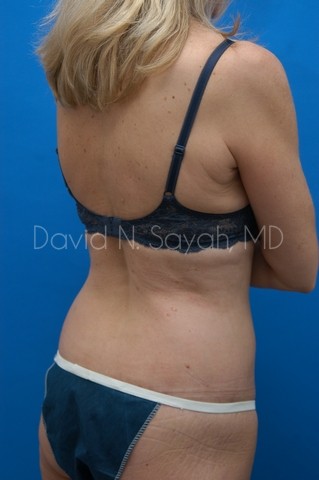 Back Tuck Belt Lipectomy Before and After | Sayah Institute