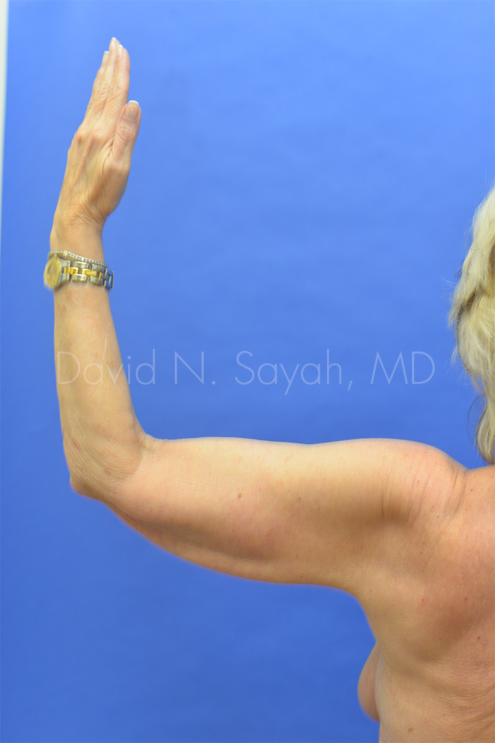 Brachioplasty Before and After | Sayah Institute