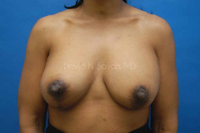 Breast Augmentation And Mastopexy Before and After | Sayah Institute