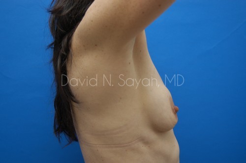 Breast Augmentation And Mastopexy Before and After | Sayah Institute