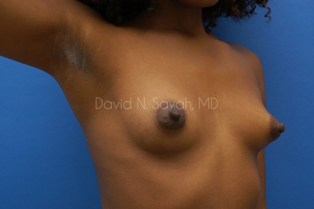 Breast Augmentation Before and After | Sayah Institute