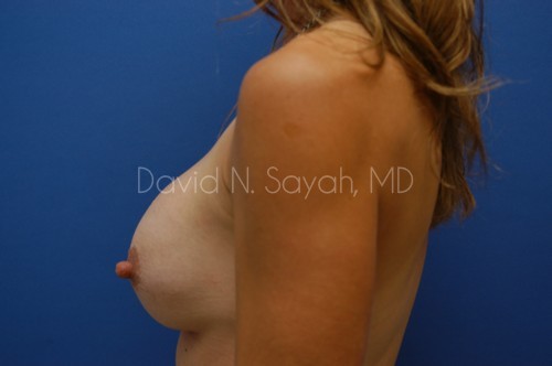 Breast Implant Exchange Before and After | Sayah Institute