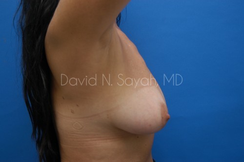 Breast Implant Exchange Before and After | Sayah Institute