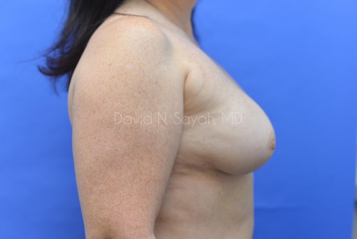 Breast Implant Removal Before and After | Sayah Institute