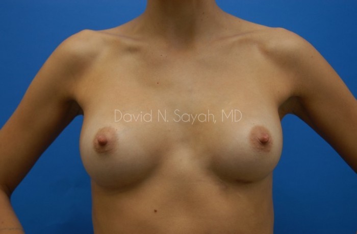 Breast Implant Revision Before and After | Sayah Institute