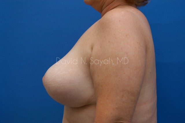 Breast Implant Revision Before and After | Sayah Institute