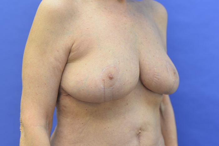Breast Lift Before and After | Sayah Institute
