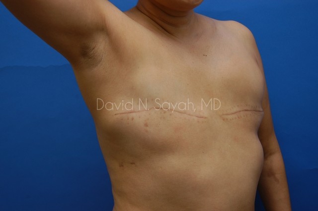 Breast Reconstruction Before and After | Sayah Institute