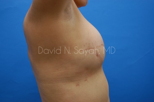 Breast Reconstruction Before and After | Sayah Institute