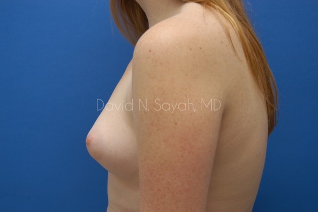 Breast Reconstruction Before and After | Sayah Institute