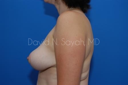 Breast Reduction Before and After | Sayah Institute