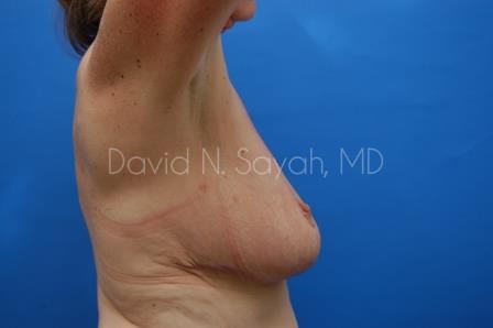 Breast Reduction Before and After | Sayah Institute
