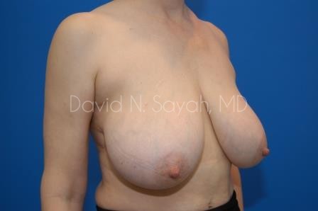 Breast Reduction Before and After | Sayah Institute