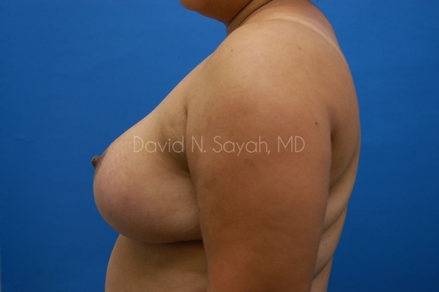 Breast Reduction Before and After | Sayah Institute