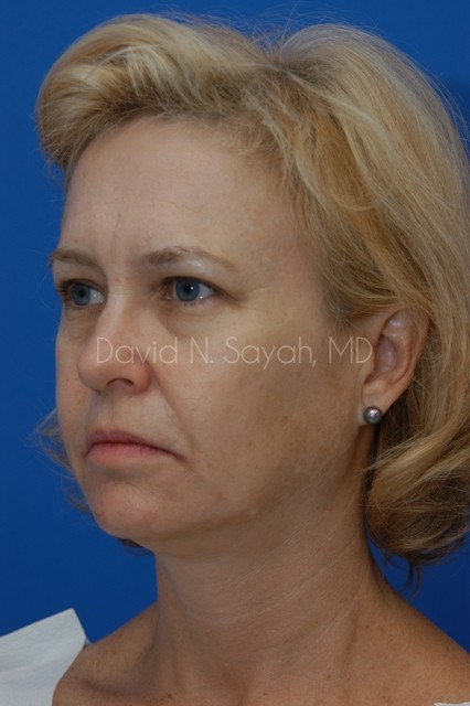 Brow Lift Before and After | Sayah Institute