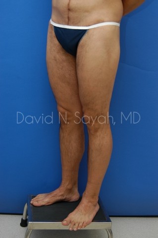 Buttock Lift Before and After | Sayah Institute