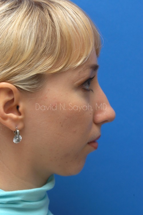 Chin Implant Before and After | Sayah Institute