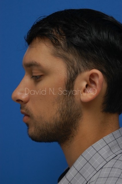 Ear Surgery Before and After | Sayah Institute