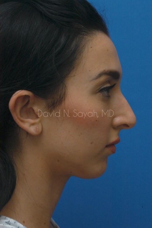 Ear Surgery Before and After | Sayah Institute