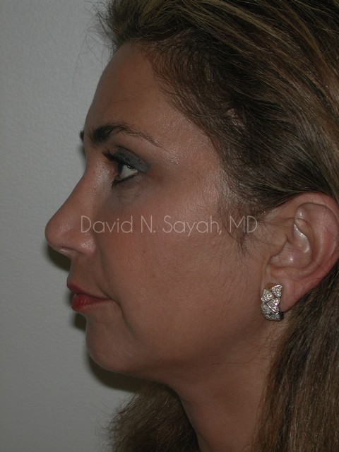 Endoscopic Brow Lift Before and After | Sayah Institute