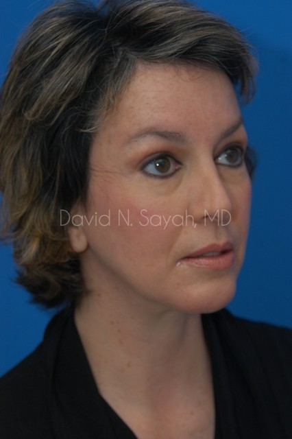 Endoscopic Facelift Before and After | Sayah Institute