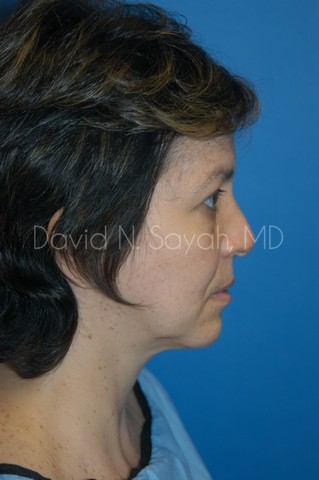 Endoscopic Facelift Before and After | Sayah Institute