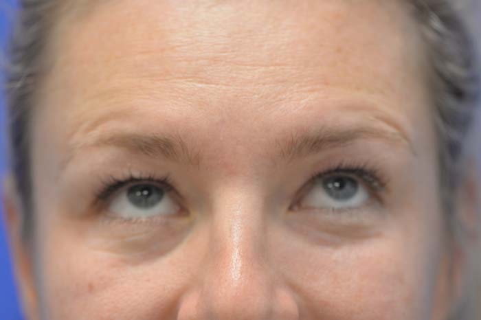 Eyelid Surgery Before and After | Sayah Institute