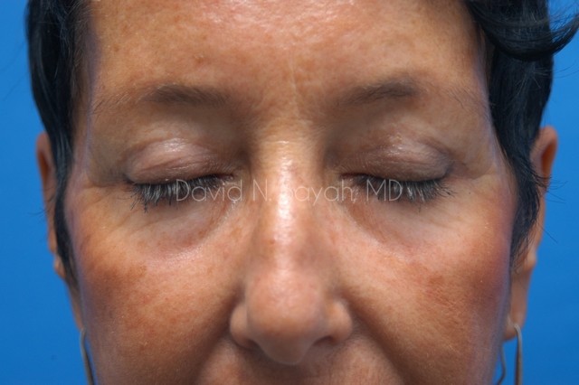 Eyelid Surgery Before and After | Sayah Institute