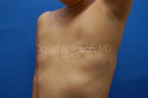 Fat Injection Breast Before and After | Sayah Institute