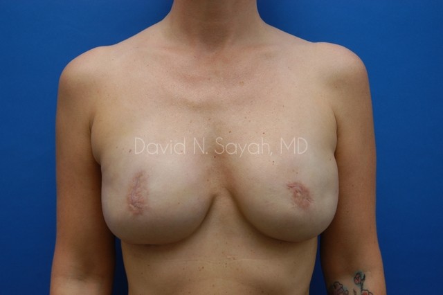 Fat Injection Breast Before and After | Sayah Institute