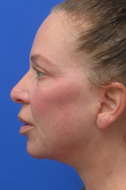 Fat Injection Face Before and After | Sayah Institute