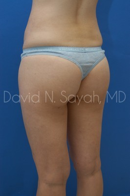 Gluteal Augmentation Before and After | Sayah Institute