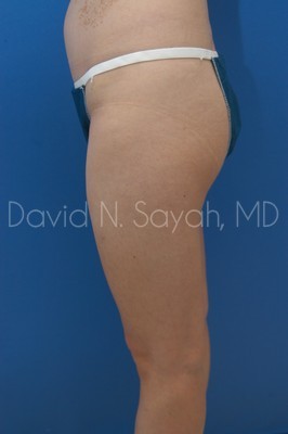 Gluteal Augmentation Before and After | Sayah Institute