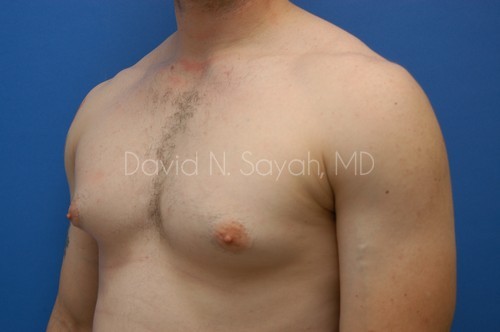 Liposuction Before and After | Sayah Institute