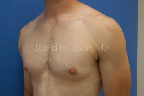 Liposuction Before and After | Sayah Institute