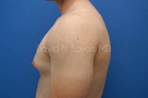 Liposuction Before and After | Sayah Institute