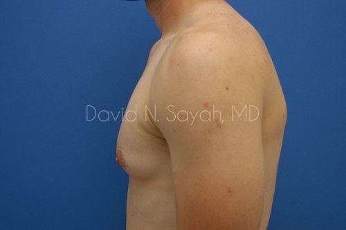 Liposuction Before and After | Sayah Institute