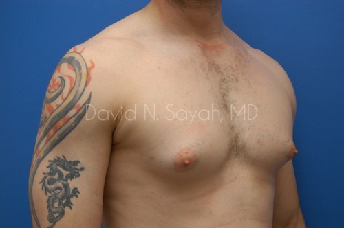 Liposuction Before and After | Sayah Institute