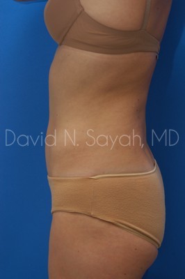 Liposuction Before and After | Sayah Institute