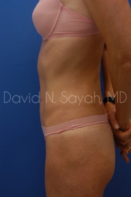 Liposuction Before and After | Sayah Institute