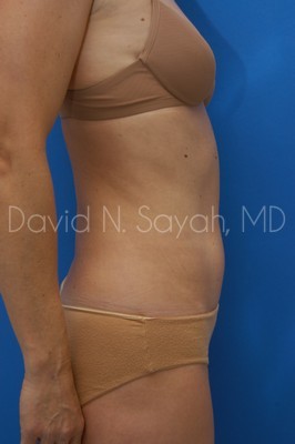 Liposuction Before and After | Sayah Institute