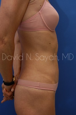 Liposuction Before and After | Sayah Institute