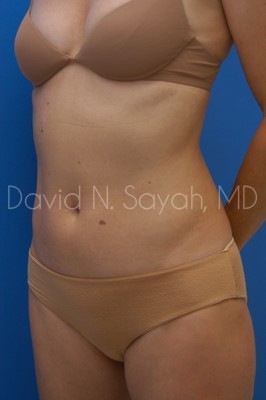 Liposuction Before and After | Sayah Institute