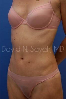 Liposuction Before and After | Sayah Institute