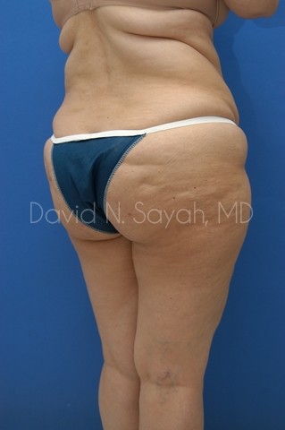Liposuction Before and After | Sayah Institute