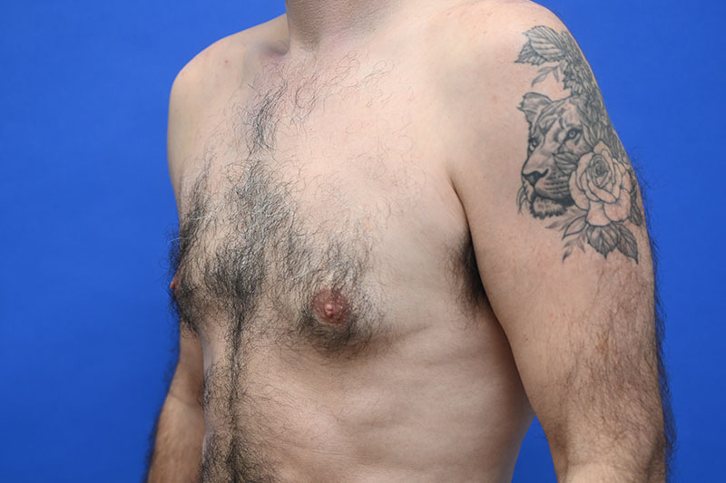 Male Breast Surgery Before and After | Sayah Institute