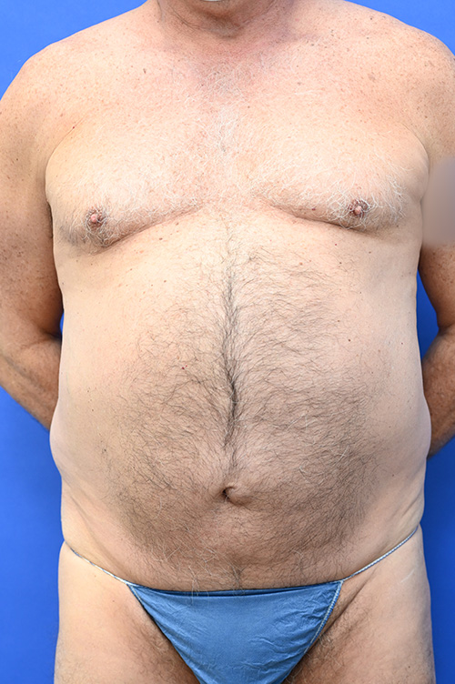 Male Breast Surgery Before and After | Sayah Institute