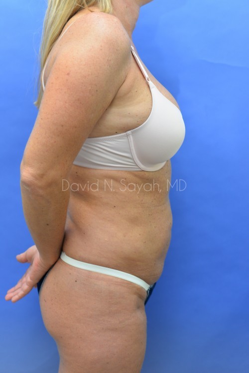 Mini Tummy Tuck Before and After | Sayah Institute