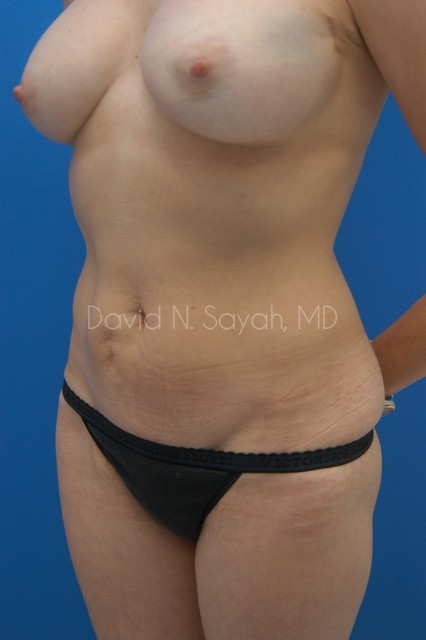 Mini Tummy Tuck Before and After | Sayah Institute