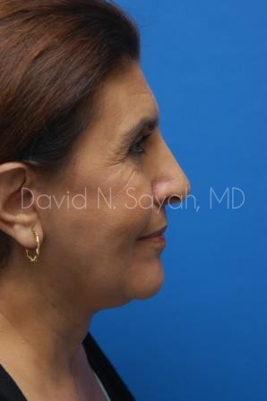 Neck Lift Before and After | Sayah Institute